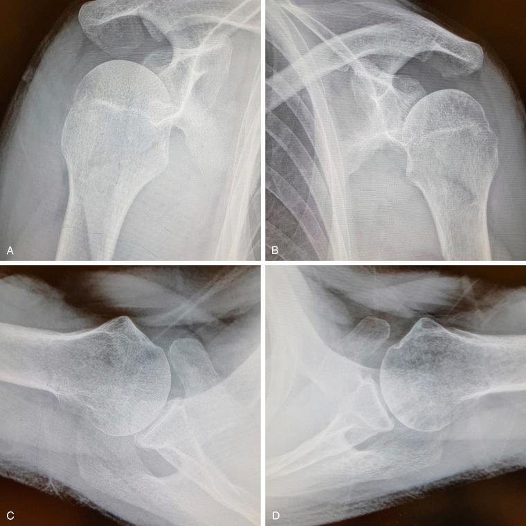 FIG. 28.3, (A–D) Bilateral simple X-ray showing osteopenia in the involved humeral head. It also shows typical findings of impingement and rotator cuff tear, which are greater tuberosity sclerosis, osteophytes, sometimes subchondral cyst and acromion traction spurs.