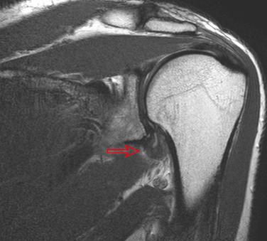 FIG. 28.4, Left shoulder MRI showing thickened inferior joint capsule ( red arrow ) with loss of the axillary pouch. This is the characteristic MRI finding in typical frozen shoulder patients.