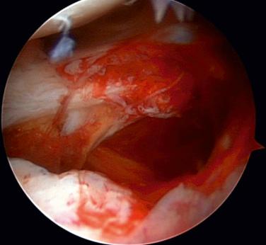 FIG. 28.5, Rupture of the anteroinferior capsule after gentle forward flexion manipulation. It usually ruptures in this portion in typical frozen shoulder.