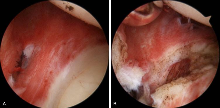 FIG. 28.6, (A) Inflammation on the posterior capsule. (B) After releasing the posterior capsule with radio-frequency and scissors.