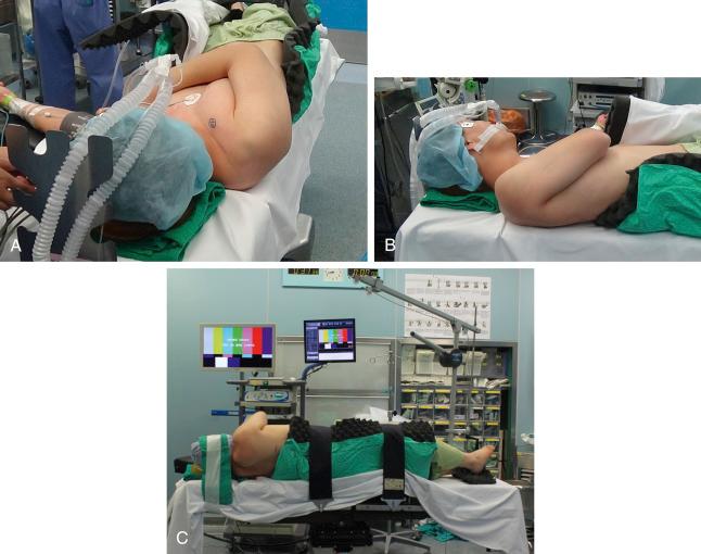 FIG. 28.8, Lazy lateral decubitus position, 30-degree tilt from the floor. (A) Top view. (B) Lateral view. (C) Lazy lateral decubitus position, 30-degree tilt from the floor.