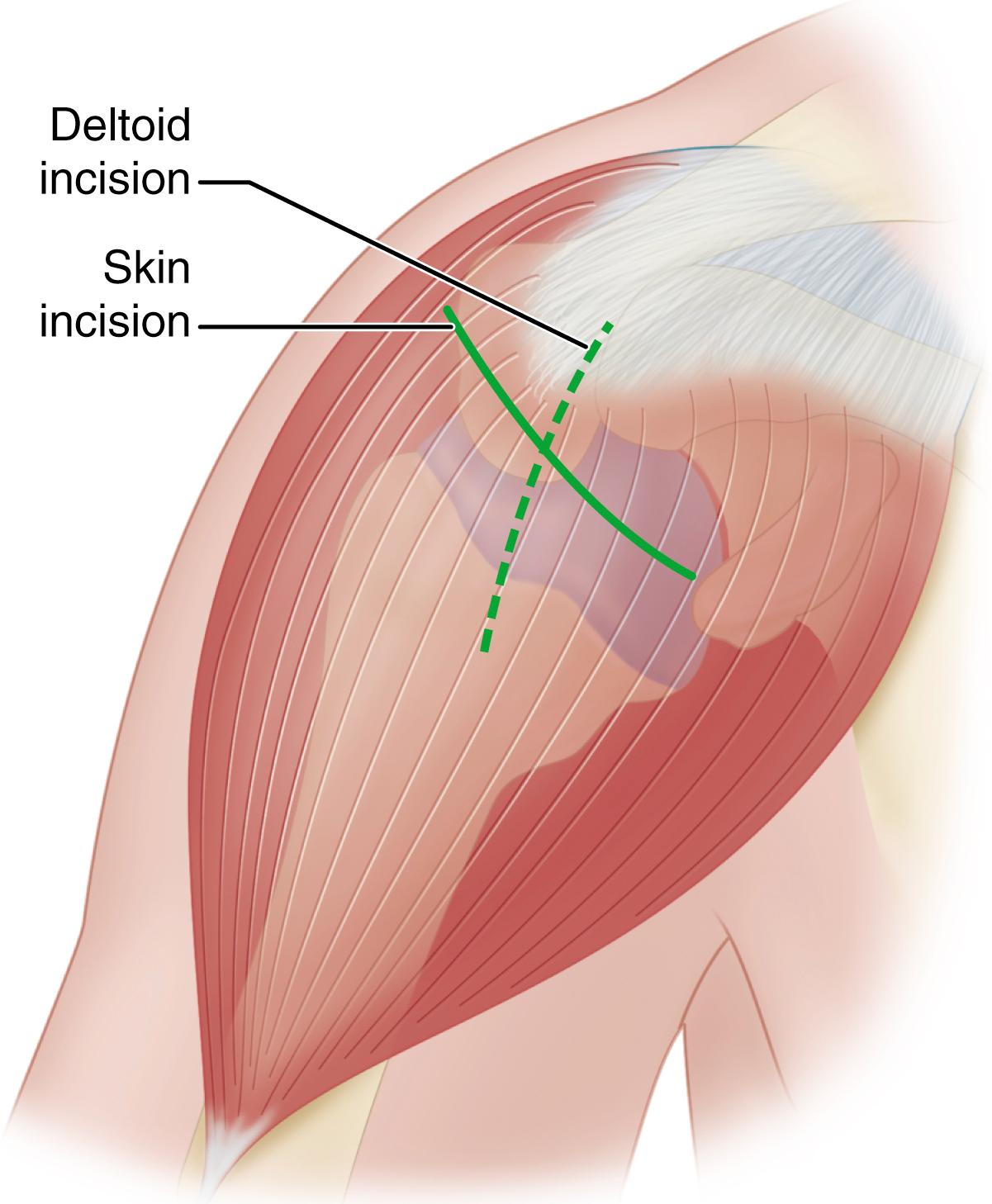 FIGURE 46.13, Anterior acromioplasty. Skin incision is made in skin lines across anterior corner of acromion. Acromion is exposed by incision in tendon between anterior and lateral deltoid. SEE TECHNIQUE 46.1.