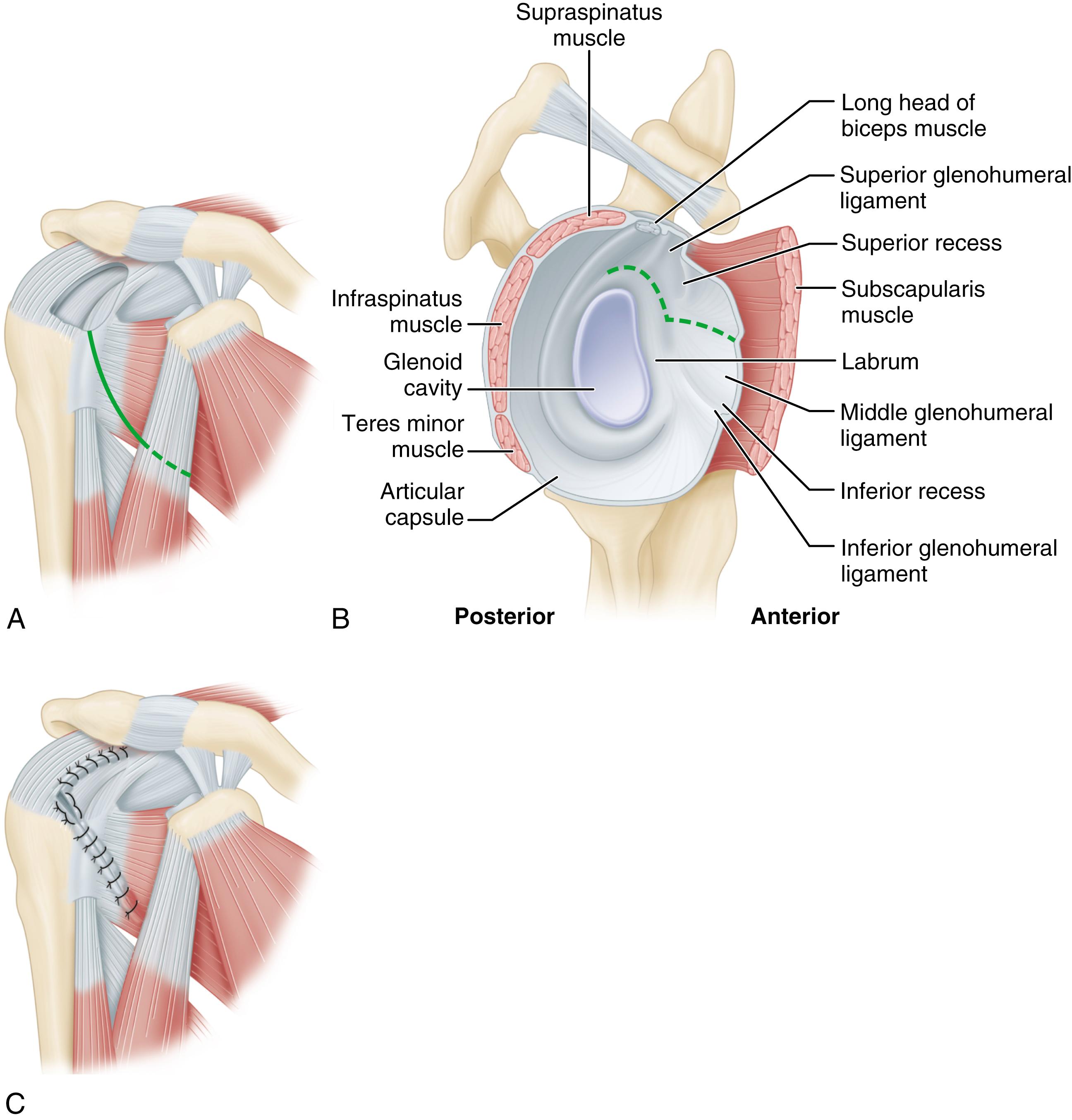 FIGURE 46.17, Cofield subscapularis transposition. A, Incision necessary for superior transposition of subscapularis tendon. B, Line of shoulder capsule incision. Inferior-middle glenohumeral ligament and subscapularis tendon and muscle are separated from capsule. C, Tendon-to-bone and tendon-to-tendon repair of transposed subscapularis.