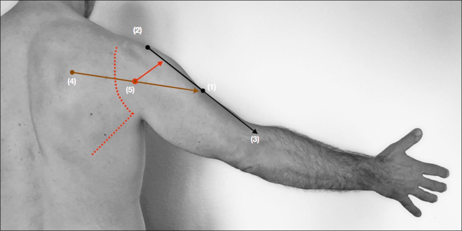 Fig. 39.2, Surface marking of the axillary nerve. The deltoid tuberosity is at the midpoint of the humerus (1), on a line (black) midway between the lateral border of the acromion (2) and the lateral epicondyle (3). With the arm in abduction, the inferior border of the posterior part of deltoid is a straight line (brown) between the medial border of the scapula at the base of the spine of scapula (4) and the deltoid tuberosity (1). The axillary nerve passes directly posteriorly, towards the palpating finger at the midpoint of the posterior border of deltoid (5). It then passes around the humerus at about the midpoint of the muscle (solid orange line). The literature is replete with many estimations of the variability of the distance between the acromion and the axillary nerve deep to deltoid; this rule of thumb is practical and based on the individual's size. Incisions for the exposure of the posterior aspect of the shoulder joint and for the scapula (e.g. for fixation of a scapular fracture, posterior stabilization of the shoulder, and latissimus dorsi tendon transfer, dotted orange line) are medial to this point (5). The posterior cutaneous nerve of the upper arm passes from deep to the posterior border of deltoid at (5) and supplies the skin at (1).