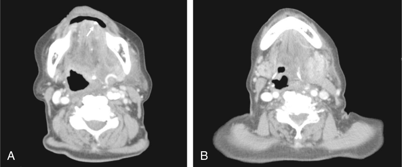 Fig. 7.1.1, (A) A calculus measuring 3 mm (arrow) at the distal end of the left submandibular duct with upstream ductal dilatation and hypodense soft tissue/fluid medial to the left submandibular gland. (B) Enlarged and enhancing left submandibular gland causing prominent mass effect on the adjacent oropharynx.