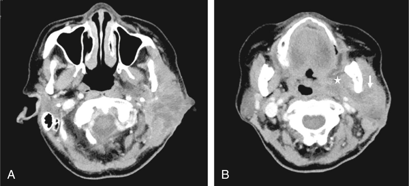 Fig. 7.1.2, (A) Multiloculated abscess in the left superficial parotid gland. (B) Ill-defined hypodense areas in the superficial and deep lobes of the left parotid gland (arrow) suggestive of necrosis, with hypodense fluid tracking into the left parapharyngeal space (star).
