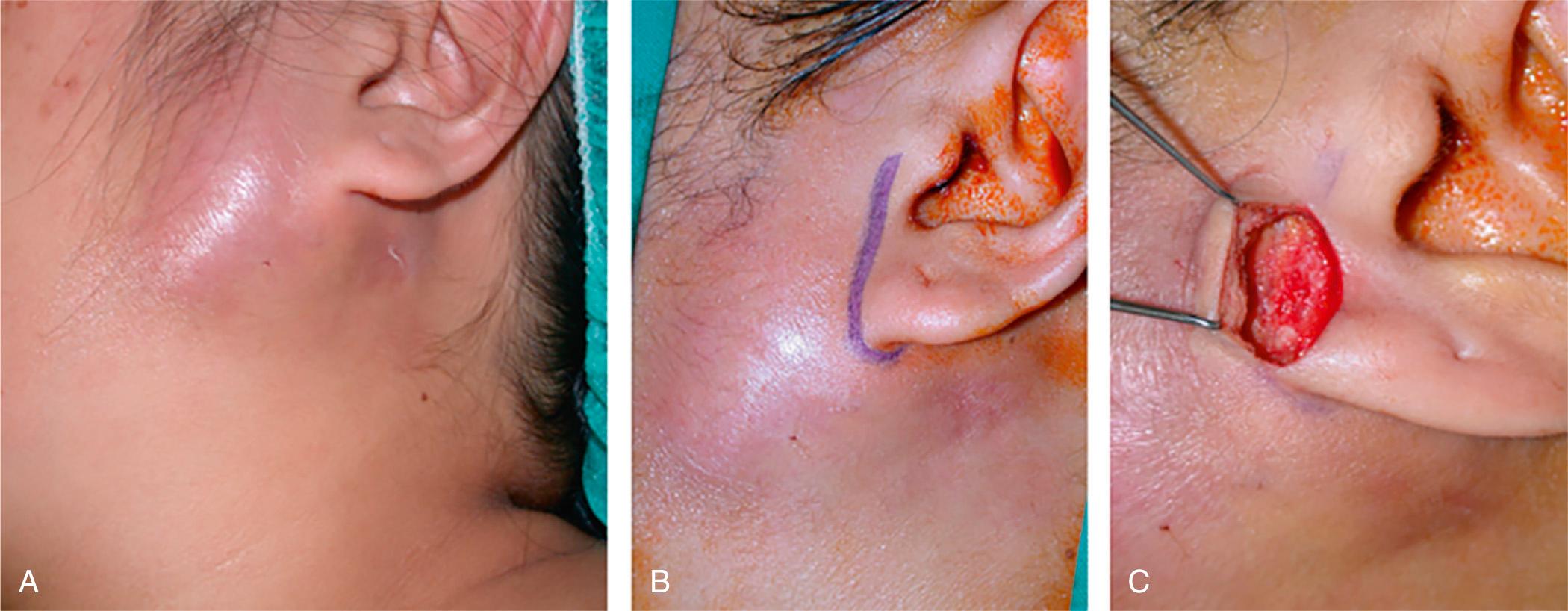 Fig. 7.1.3, (A) Left parotid abscess with overlying skin changes and lifting of the earlobe. (B) Superior limb of modified Blair incision is marked out prior to incision and drainage of the abscess. (C) A skin flap is raised to attain exposure of the parotid gland.