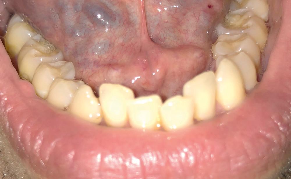 Fig. 13.1, Wharton's papilla – located in the anterior floor of mouth posterior to the mandibular incisor teeth.