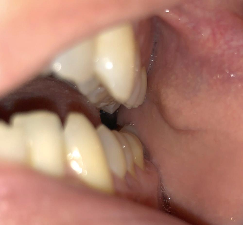 Fig. 13.2, Stensen's papilla – located in the buccal mucosa opposite the second maxillary molar.