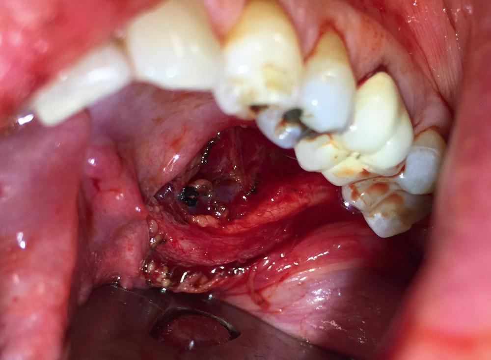 Fig. 13.3, Floor of mouth anatomy in a patient after sublingual gland excision demonstrating the relationship of the submandibular duct crossing the lingual nerve.