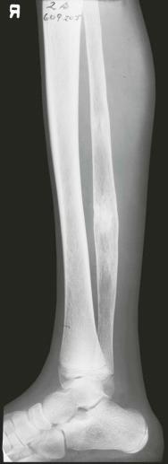 eFIGURE 74–1, Lateral tibia and fibula in child with sickle cell disease showing coarsened trabecular pattern and slight widening of the medullary spaces.