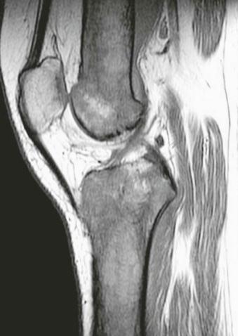 eFIGURE 74–2, Lateral knee in patient with long-standing sickle cell disease showing marked diffuse marrow replacement.