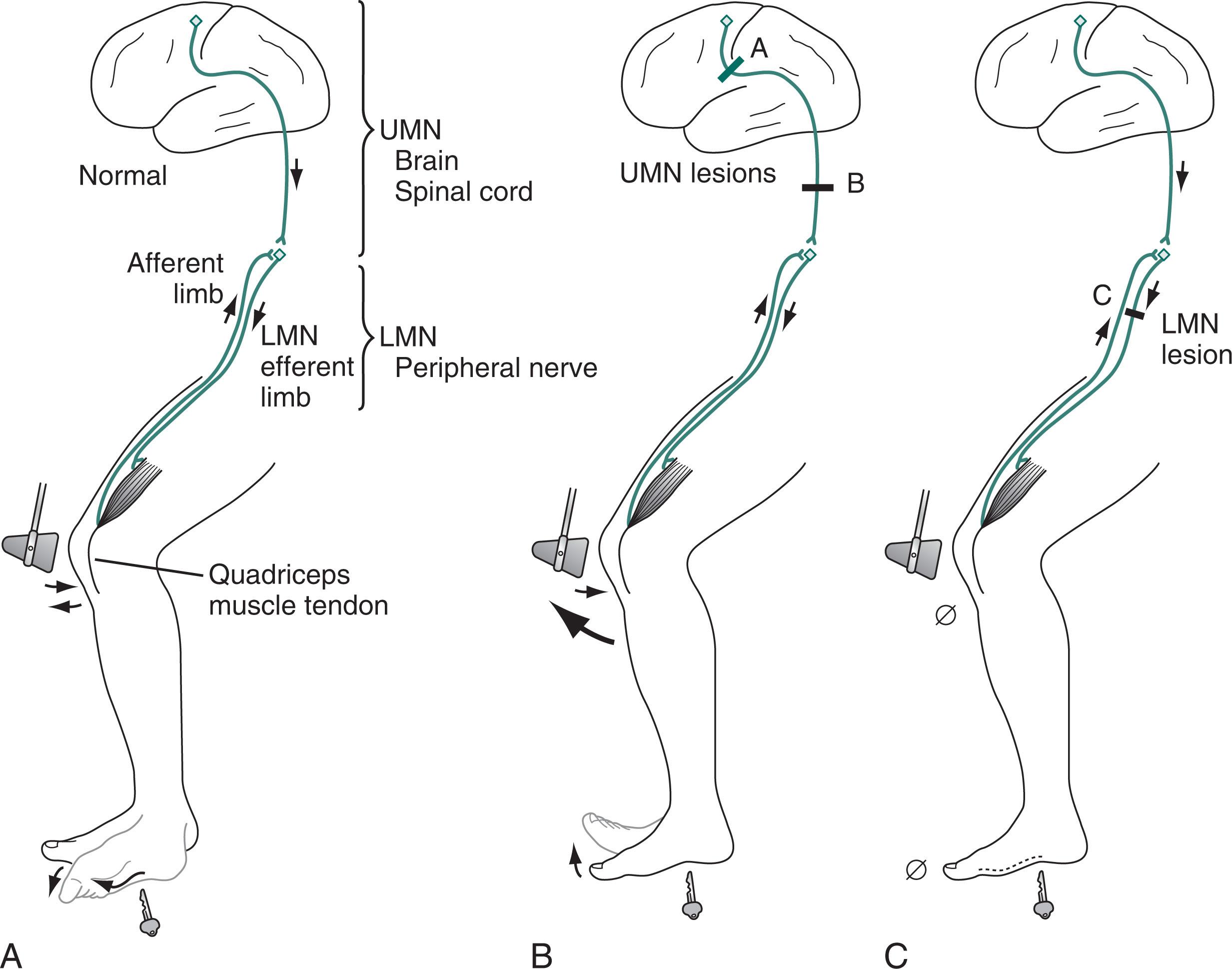 Fig. 2.2, (A) Normally, when neurologists strike a patient’s quadriceps tendon with a percussion hammer, the maneuver elicits a DTR. In addition, when neurologists stroke the sole of the foot to elicit a plantar reflex, the big toe normally bends downward (flexes). (B) When brain or spinal cord lesions injure the corticospinal tract, producing upper motor neuron (UMN) damage, DTRs react briskly and forcefully, i.e., DTRs are hyperactive. As another sign of UMN damage, the plantar reflex is extensor (a Babinski sign). (C) In contrast, peripheral nerve injury causes lower motor neuron (LMN) damage, the DTR is hypoactive, and the plantar reflex is absent. DTR , Deep tendon reflex