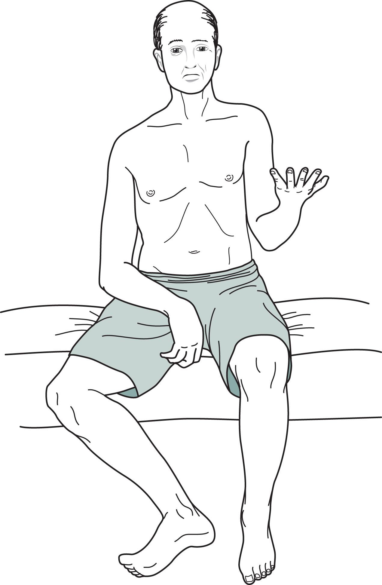 Fig. 2.3, This patient shows right hemiparesis. The right-sided facial weakness causes the widened palpebral fissure and flat nasolabial fold; however, the forehead muscles remain normal (see Chapter 4 regarding this discrepancy). The right arm is limp, and the elbow, wrist, and fingers take on a flexed position; the right leg is externally rotated; and the hip and knee are extended.