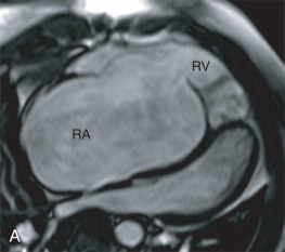 FIG. 41.1, Balanced steady-state free precession four-chamber view of a patient with Ebstein anomaly (A) demonstrating the severely dilated right atrium (RA) and the relatively smaller right ventricle. End-diastolic contours (B) outlining the RA, the atrialized right ventricle ( aRV, the portion of the right ventricle distal to the anatomic tricuspid valve annulus but proximal to the coaptation point of the tricuspid valve) and the functional right ventricle ( fRV ; the portion of the right ventricle distal to the coaptation of the tricuspid valve).