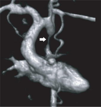 FIG. 41.2, Three-dimensional volume-rendered magnetic resonance angiogram in a patient with an aortic coarctation (arrow). Note the large left internal thoracic artery that functions as a bridging collateral and is a sign of hemodynamically significant coarctation.