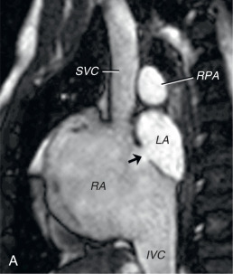 FIG. 40.2, Secundum atrial septal defect. (A) Oblique balanced steady-state free precession (bSSFP) cine showing a centrally located defect (arrow) . (B) Color-coded velocity-encoded cine showing flow from the left atrium (LA) to the right atrium (RA) through the defect. IVC, Inferior vena cava; RPA, right pulmonary artery; SVC, superior vena cava.
