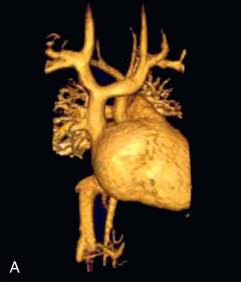 FIG. 40.3, Sinus venous atrial septal defect. (A) Volume rendered contrast-enhanced three-dimensional magnetic resonance angiography showing several pulmonary veins from the right upper lobe draining into the superior vena cava. (B) Cine balance steady-state free precession (bSSFP) in the sagittal plane showing the defect (*) between the right upper pulmonary vein (RUPV) and the superior vena cava (SVC). (C) Cine bSSFP in the axial plane showing the defect (*) between the RUPV and the SVC . The arrow points to the left atrial orifice of the RUPV. A left-to-right shunt results from drainage of the RUPV to the SVC and from left atrial blood entering the right atrium through the orifice of the RUPV (arrow) and the unroofed wall between the RUPV and the SVC (*). Ao, Ascending aorta; LA, left atrium.