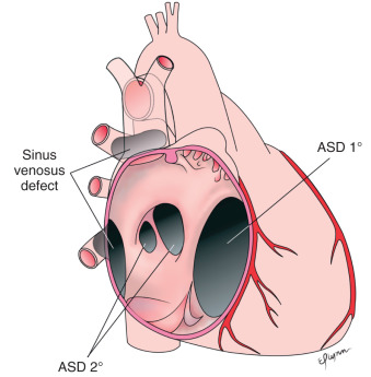 FIG. 40.1, Anatomic types of atrial communications (see text for details). Atrial septal defect: ASD 1 0 denotes primum atrial septal defect; ASD 2 0 denotes secundum atrial septal defect.