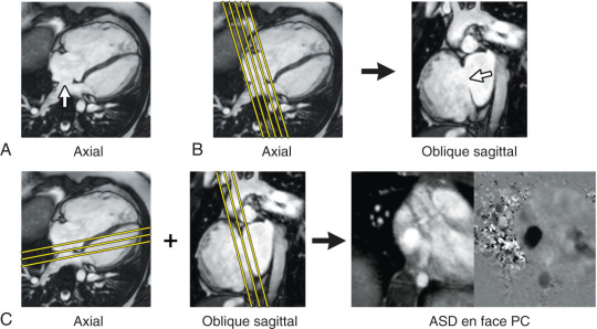 FIG. 40.4, Atrial septal defect (ASD) imaging protocol. (A) Axial cine balanced steady-state free precession (bSSFP) image showing a large secundum ASD (white arrow) . (B) The axial bSSFP image is used to plan a stack of oblique sagittal cine bSSFP images to visualize the ASD and the superior and inferior defect margins. (C) The axial and oblique sagittal images are used together to plan a stack of velocity-encoded phase contrast (PC) cine images to visualize the ASD flow en face. This provides insight into the oval shape of the defect and may demonstrate additional ASDs.