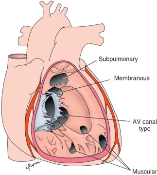 FIG. 40.5, Anatomic types of ventricular septal defects (see text for details). AV, Atrioventricular.