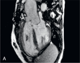 FIG. 40.6, Malalignment conoventricular septal defect (*) imaged with cine balanced steady-state free precession in ventricular long-axis (A) and short-axis (B).