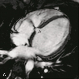 FIG. 40.7, Muscular ventricular septal defect (*) imaged with cine balanced steady-state free precession in ventricular long-axis (A) and short-axis (B) views. Note the turbulent flow jet seen in the right ventricle.