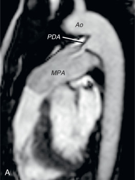 FIG. 40.8, Patent ductus arteriosus (PDA). (A) Cine balanced steady-state free precession image in an oblique sagittal plane showing a small patent ductus arteriosus. (B) Color-coded velocity-encoded cine showing flow through the PDA. Ao, Aorta; MPA, main pulmonary artery.