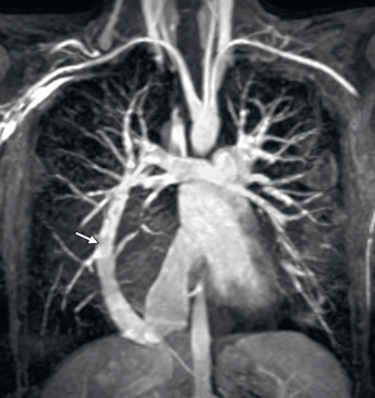 FIG. 40.9, Partially anomalous pulmonary venous connection. Contrast-enhanced three-dimensional magnetic resonance angiography showing drainage of the right upper pulmonary vein (arrow) to the inferior vena cava–right atrial junction in a patient with scimitar syndrome.