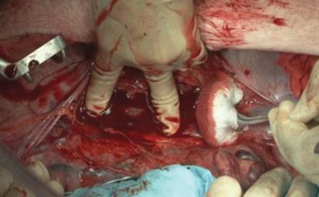 FIGURE 1, A standardized through and through injury to the inferior vena cava in a porcine model during an ATOM course