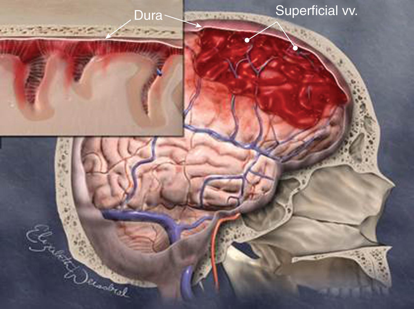 FIGURE 7, Selected damage control neurosurgery image from revised ASSET manual and ASSET plus course.