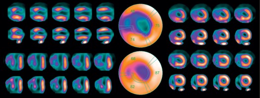 Figure 3.3, Myocardial perfusion SPECT study. Vertical (top left), horizontal (bottom left), short axis (right), and polar plots (middle) are depicted with acquisition at stress and rest aligned in the top and the bottom rows, respectively. The polar plots in the middle show a resting apical perfusion defect with partial reversibility particularly in the septal wall, indicating nontransmural apical scar with additional septal ischemia.