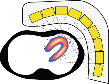 Figure 3.6, The small form factor of CZT detectors allows mounting a large array of detectors on an arch aligned around the patient and focused on the heart. Thus, rotation of the detectors around the patient is unnecessary, and instantaneous tomographic acquisition of the heart becomes possible.