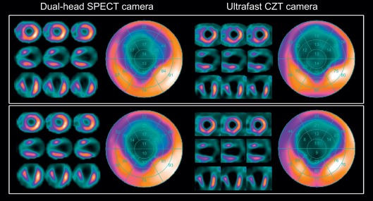 Figure 3.7, Comparison between conventional SPECT imaging with 15 min acquisition time and CZT imaging with an acquisition time of 3 min for stress (top row) and 2 min for rest (bottom rows).