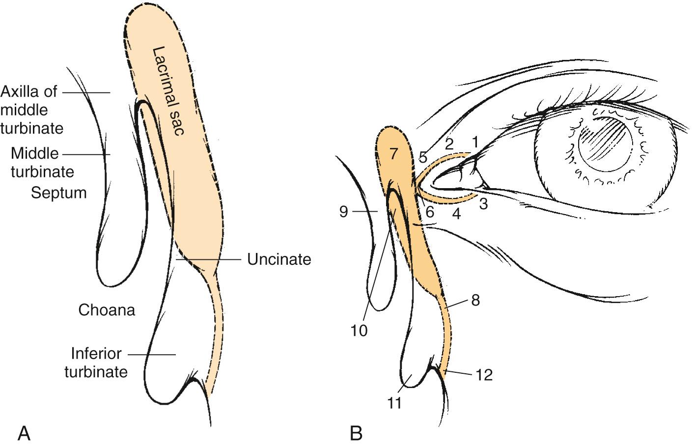 Fig. 49.1, (A) Position of lacrimal sac, as seen during endonasal visualization. The lacrimal sac and duct is located under the mucosa and the frontal process of the maxilla in a position outlined by the dotted line. (B) Anatomy of the left lacrimal apparatus. 1 , Superior punctum; 2 , superior canaliculus; 3 , inferior punctum; 4 , inferior canaliculus; 5 , medial canthal ligament; 6 , common canaliculus; 7 , lacrimal sac; 8 , lacrimal duct; 9 , middle turbinate; 10 , lacrimal bone; 11 , inferior turbinate; 12 , Hasner valve.