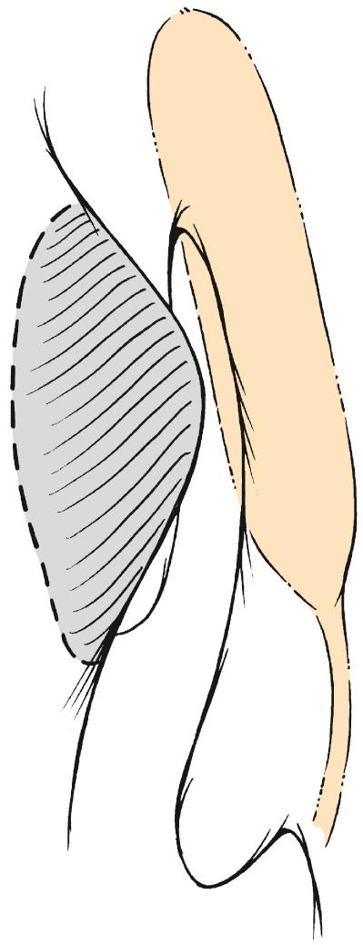 Fig. 49.4, High endoscopic septoplasty.