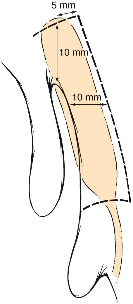 Fig. 49.5, Detail of dacryocystorhinostomy flap with suggested measurements.