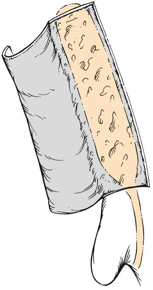 Fig. 49.6, Mucosal flap elevated off the frontal process of the maxilla and rolled over the middle turbinate. The flap must be aggressively mobilized off the axilla of the middle turbinate to allow adequate superior and posterior bony removal.