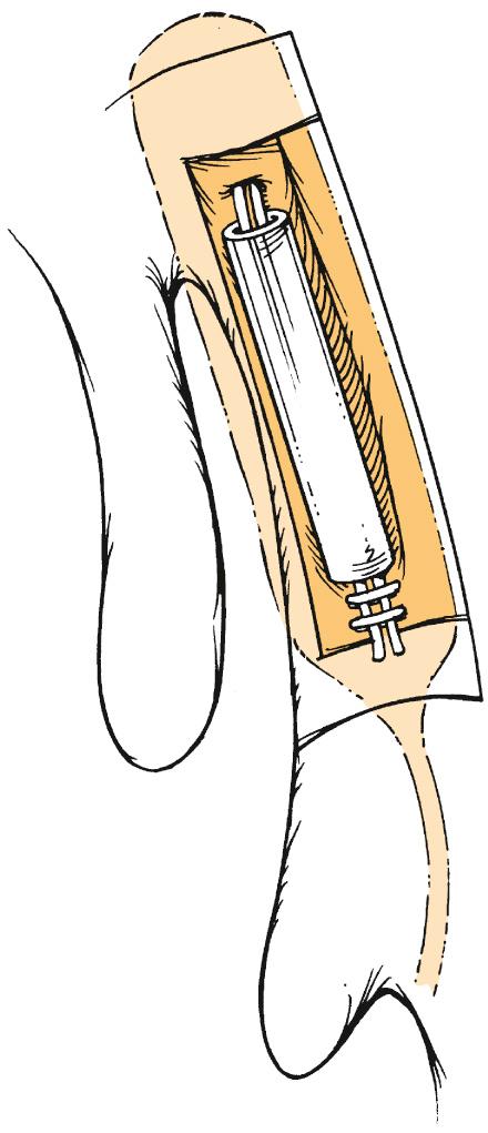 Fig. 49.9, Close-up of view of completed dacryocystorhinostomy.