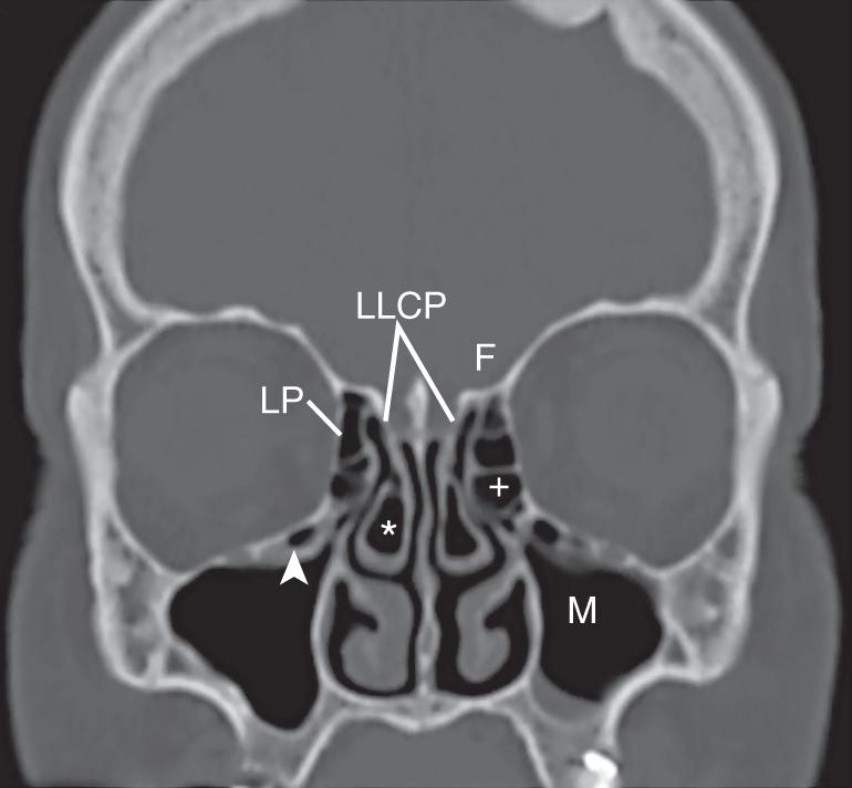 Fig. 23.1, Coronal computed tomography (CT) scan image in a bone window algorithm showing pneumatization in the head of the middle turbinate (*), also called a concha bullosa. Infraorbital ethmoid air cells (Haller cells) are seen as pneumatized air cells off the inferior orbital floor (arrow). This can narrow the drainage of the maxillary sinus (M). The lateral wall of the ethmoid cavity is the lamina papyracea (LP), lateral to which is the orbit. The olfactory cleft and lateral lamella of the cribriform plate (LLCP) are depicted. Note the relationship of the LLCP with the insertion of the basal lamella of the middle turbinate, as well as the fovea ethmoidalis (F) laterally. The LLCP is commonly asymmetric. This asymmetric anatomic variation should be recognized on presurgical planning to prevent iatrogenic cerebrospinal fluid leaks. The ethmoid bulla is seen adjacent to the LP (+).