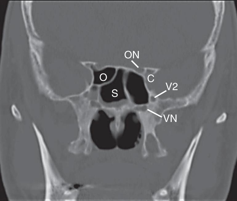 Fig. 23.2, Coronal computed tomography (CT) scan in a bone window algorithm showing a right sphenoethmoidal air cell (Onodi cell) located superior and lateral to the sphenoid sinus (S). The optic nerve (ON) and carotid artery (C) are seen as bony protrusions in the sphenoethmoidal air cell (O) rather than the sphenoid sinus. The Vidian nerve (VN) and the maxillary division of the trigeminal nerve (V2) can be seen inferiorly and laterally.