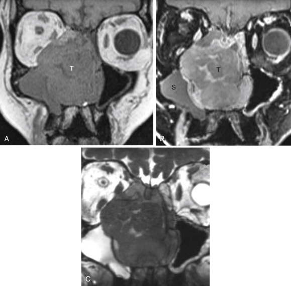 FIGURE 12-5, Differentiation of tumor versus inflammation on magnetic resonance imaging. A, Coronal T1-weighted imaging (T1WI) shows a bulky enhancing mass (T) within the nasal cavity. The mass is invading the right inferomedial orbit. It is unclear whether the maxillary sinus next door is full of tumor or secretions blocked within the sinus due to obstruction at the ostiomeatal complex. B, Coronal enhanced fat-suppressed T1WI demonstrates solid enhancement within this neoplasm (T). Note that much of the material within the right maxillary sinus does not enhance, indicating backed-up secretions (S). Thus with contrast, the border of the tumor is well delineated. C, In this case, there is also marked signal difference between the tumor and the secretions in the maxillary sinus on coronal T2WI, but the distinction on T2 is not always quite so clear, as a result of proteinaceous material that can develop within sinus contents.