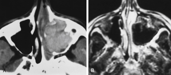 FIGURE 12-15, Fungal sinusitis. A, Unenhanced computed tomographic scan shows a hyperdense opacified left maxillary antrum. B, On T2-weighted imaging, the secretions were black, suggesting inspissation, paramagnetic accumulation, or fungal sinusitis. Cultures grew Drechslera fungi.