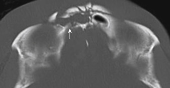 FIGURE 12-16, Trauma to the frontal sinus. When a fracture goes through both walls of the frontal sinus, the potential for a cerebrospinal fluid leak, meningitis, pseudomeningoceles, and intracranial hemorrhagic complications increases. Note extensively comminuted fractures of the frontal sinus with focal defect at the posterior wall of frontal sinus (arrow).