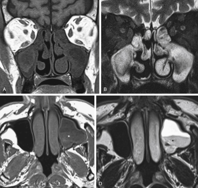 FIGURE 12-17, Proteinaceous sinonasal secretions on magnetic resonance imaging. A, On coronal T1-weighted imaging (T1WI) and (B) coronal T2WI, the maxillary sinus contents show mixed signal intensity indicating variable concentrations of proteinaceous secretions. In a different patient, (C) axial T1- and (D) axial T2-weighted images show simpler fluid layering non-dependently within the left maxillary sinus, and more proteinaceous contents layering dependently (asterisks). In general, signal from lowest protein content to highest protein content progresses from dark T1-bright T2 to bright T1-bright T2 to bright T1-dark T2, and finally dark T1-dark T2 signal intensity.