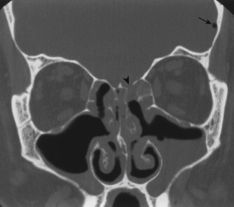 FIGURE 12-18, Postoperative study after uncinectomies and ethmoidectomies. Despite the surgery to open the ostia and ethmoid sinuses, this patient continued to have acute maxillary sinusitis attacks (note the air-fluid levels on the coronal prone study) and chronic mucosal changes in the ethmoid sinuses. Extra credit: Did you catch the dehiscent area in the left fovea ethmoidalis (arrowhead)? This may be a manifestation of the disease or the surgery. The dot of intracranial air (arrow) is the second edge of the film diagnosis.