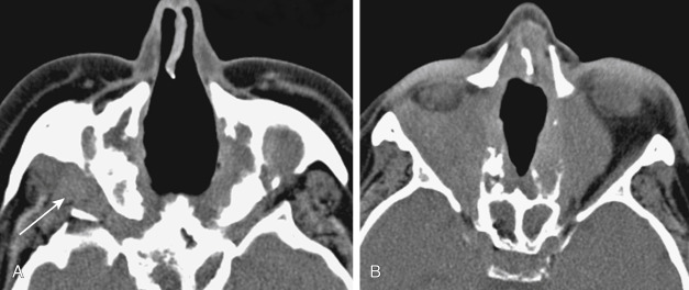 FIGURE 12-19, Septal perforations. A, This patient had granulomatosis with polyangiitis (formerly Wegener granulomatosis). The nasal septum is gone and the patient had infiltration of the orbits and the soft tissue around the right maxillary antra (arrow). B, Similar findings with septal and lateral nasal wall destruction as well as orbital soft tissue extension are seen in this case of sarcoidosis.