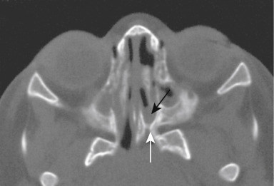 FIGURE 12-6, Membranous and bony choanal atresia. On the left side the nasal passageway narrows, the vomer is thicker on that side, and both a bony (posterior; white arrow ) and soft tissue (anterior; black arrow ) plug is seen. No luck passing the tube on the left side.