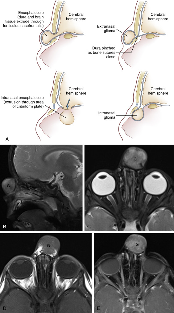 FIGURE 12-7, Congenital nasal lesions. A, Schematic representation of encephaloceles (left) and nasal gliomas (right). Sagittal T2 (B), axial T2 (C), and axial precontrast (D) and postcontrast (E) T1-weighted images show an extranasal soft-tissue mass (G) looking kind of brainy with mild enhancement; there is no attachment to the intracranial structures. Again, not nasal and not glioma = nasal glioma (go figure!).