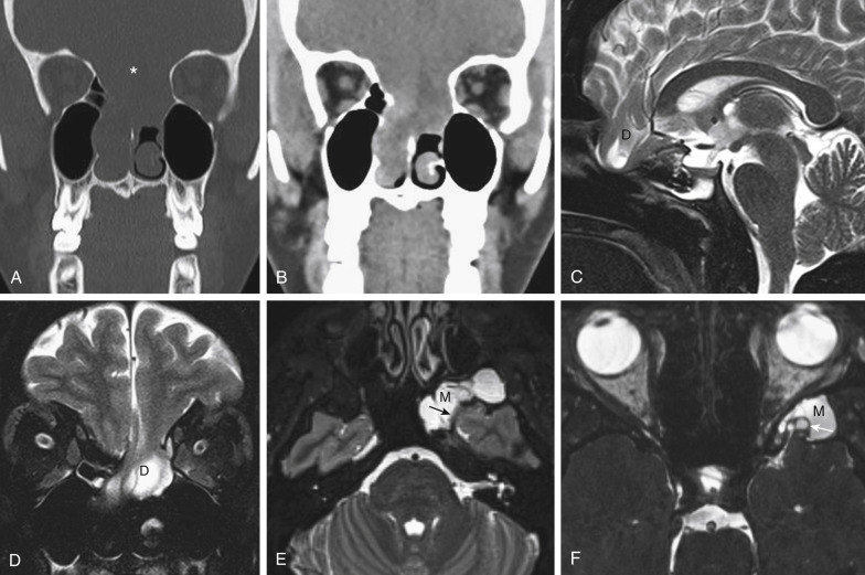 FIGURE 12-8, Meningoencephaloceles galore. Contrast the previous case with this one. An intranasal meningoencephalocele is seen on coronal computed tomography in bone (A) and soft-tissue (B) windows. There is a large deficiency at the cribriform plate (asterisk), allowing for herniation of brain tissue into the nasal cavity. Sagittal imaging (C) and coronal (D) T2-weighted imaging (T2WI) confirm the herniation of brain tissue (D) into the nasal cavity. Note the T2 hyperintensity within the herniated tissue, indicating dysplastic brain. E, And one more…on this axial T2WI, you might be fooled into calling this a lateralized sphenoid sinus filled with snot but it’s not (heh heh). Note the focal deficiency of the middle cranial fossa transmitting a small amount of brain tissue (arrow), making this a meningoencephalocele (M). F, For you nonbelievers out there, slightly more superiorly in this same patient, axial T2 constructive interference in steady state imaging shows another defect along the middle cranial fossa, transmitting clearly dysplastic brain tissue (arrow) into the aerated but opacified sphenoid wing, again cinching the diagnosis of meningoencephalocele (M).